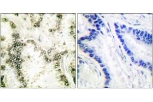 Immunohistochemistry analysis of paraffin-embedded human lung carcinoma tissue, using Ku70 Antibody.