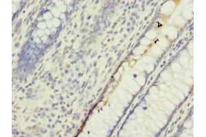 Immunohistochemistry of paraffin-embedded human colon cancer using ABIN7174232 at dilution of 1:100