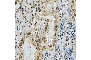 Immunohistochemical analysis of ZNF436 staining in human lung cancer formalin fixed paraffin embedded tissue section. (ZNF436 anticorps)