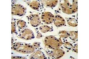 FAT10 antibody immunohistochemistry analysis in formalin fixed and paraffin embedded human stomach carcinoma. (UBD anticorps  (AA 120-153))