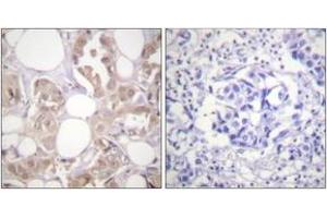 Immunohistochemistry analysis of paraffin-embedded human breast carcinoma, using CDK7 (Phospho-Thr170) Antibody.