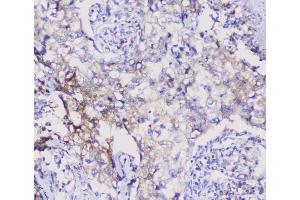 IHC analysis of NSE using anti-NSE antibody (ABIN6719549). (ENO2/NSE anticorps)