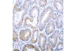 Immunohistochemical analysis of Cytokeratin 18 (pS33) staining in human colon cancer formalin fixed paraffin embedded tissue section.