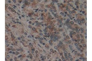 Detection of CNX in Human Prostate cancer Tissue using Polyclonal Antibody to Calnexin (CNX)