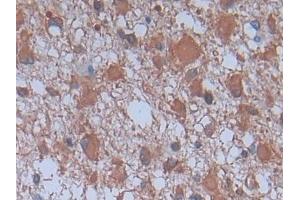 Detection of PLA2G4 in Human Glioma Tissue using Monoclonal Antibody to Cytosolic Phospholipase A2 (PLA2G4)