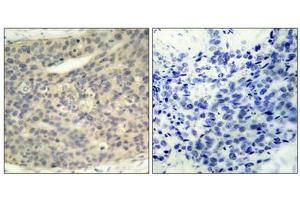 Immunohistochemical analysis of paraffin-embedded human breast carcinoma tissue using LIMK1(Phospho-Thr508) Antibody(left) or the same antibody preincubated with blocking peptide(right). (LIM Domain Kinase 1 anticorps  (pThr508))