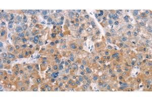 Immunohistochemistry of paraffin-embedded Human liver cancer tissue using LATS2 Polyclonal Antibody at dilution 1:30 (LATS2 anticorps)