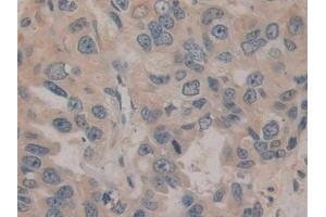 Detection of ENPEP in Human Breast cancer Tissue using Polyclonal Antibody to Aminopeptidase A (ENPEP)