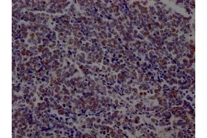 IHC image of ABIN7127456 diluted at 1:100 and staining in paraffin-embedded human lung cancer performed on a Leica BondTM system.
