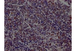 IHC image of ABIN7127456 diluted at 1:100 and staining in paraffin-embedded human lung cancer performed on a Leica BondTM system. (Recombinant LIG1 anticorps)