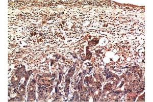 Immunohistochemical analysis of paraffin-embedded Human Stomach Carcinoma Tissue using Ubiquitin Mouse mAb diluted at 1:200.