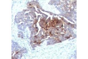 IHC testing of human ovarian carcinoma with TAG-72 antibody. (TAG-72 anticorps)