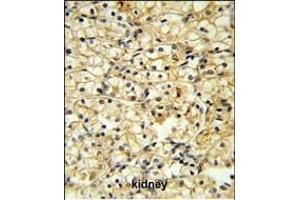 TR Antibody (C-term) 6545b IHC analysis in formalin fixed and paraffin embedded kidney carcinoma followed by peroxidase conjugation of the secondary antibody and DAB staining.