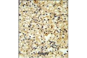 TR Antibody (C-term) 6545b IHC analysis in formalin fixed and paraffin embedded kidney carcinoma followed by peroxidase conjugation of the secondary antibody and DAB staining. (CD40 Ligand anticorps  (C-Term))