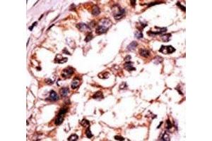 IHC analysis of FFPE human hepatocarcinoma tissue stained with the ERK3 antibody. (MAPK6 anticorps  (pSer189))