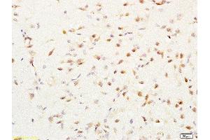 Formalin-fixed and paraffin embedded human lung cancer labeled with Rabbit Anti-MGMT Polyclonal Antibody, Unconjugated  at 1:200 followed by conjugation to the secondary antibody and DAB staining