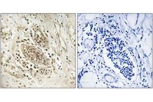 Immunohistochemistry analysis of paraffin-embedded human breast carcinoma tissue, using POLE1 Antibody.