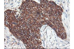 Immunohistochemical staining of paraffin-embedded Adenocarcinoma of Human breast tissue using anti-PFKP mouse monoclonal antibody. (PFKP anticorps)
