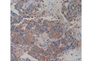 IHC-P analysis of Human Breast Cancer Tissue, with DAB staining. (alpha Actinin 4 anticorps  (AA 1-269))