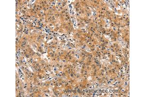 Immunohistochemistry of Human gastric cancer using DNM2 Polyclonal Antibody at dilution of 1:40 (DNM2 anticorps)