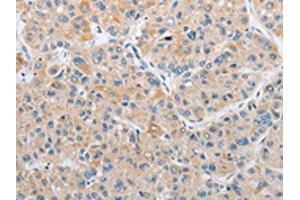 The image on the left is immunohistochemistry of paraffin-embedded Human liver cancer tissue using ABIN7128506(ARHGEF9 Antibody) at dilution 1/50, on the right is treated with fusion protein. (Arhgef9 anticorps)