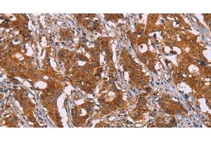 Immunohistochemistry of paraffin-embedded Human gasrtic cancer tissue using DCTN6 Polyclonal Antibody at dilution 1:40