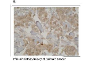 Immunohistochemistry staining of prostate cancer tissue using CYP3A7 antibody. (CYP3A7 anticorps  (C-Term))