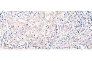 Immunohistochemistry of paraffin-embedded Human cervical cancer tissue using SLC25A27 Polyclonal Antibody at dilution of 1:30(x200) (SLC25A27 anticorps)