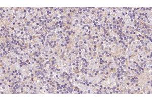 ABIN6273083 at 1/100 staining Human lymph cancer tissue by IHC-P. (TOMM40 anticorps  (Internal Region))