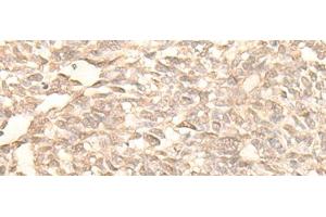 Immunohistochemistry of paraffin-embedded Human lung cancer tissue using RAD23B Polyclonal Antibody at dilution of 1:25(x200) (RAD23B anticorps)