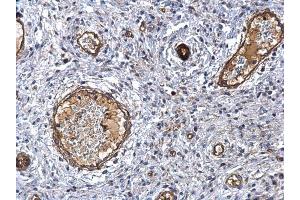 IHC-P Image MMP1 antibody detects MMP1 protein at secreted on human cervical carcinoma by immunohistochemical analysis.