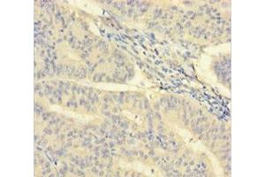 Immunohistochemistry of paraffin-embedded human endometrial cancer using ABIN7156965 at dilution of 1:100