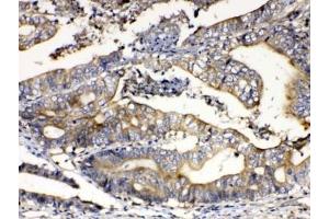IHC testing of FFPE human intestinal cancer tissue with Calpain 2 antibody at 1ug/ml. (Calpain 2 anticorps)