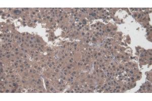 Detection of COL1a2 in Human Liver cancer Tissue using Polyclonal Antibody to Collagen Type I Alpha 2 (COL1a2) (COL1A2 anticorps  (AA 1103-1366))