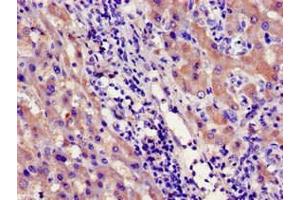 Immunohistochemistry of paraffin-embedded human liver cancer using ABIN7142182 at dilution of 1:100 (CYP39A1 anticorps  (AA 235-392))