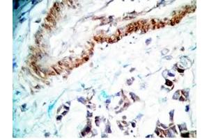 Human stomach cancer tissue was stained by rabbit Anti-Spexin prepro (36-58)  (H) Antiserum (Spexin anticorps  (Preproprotein))