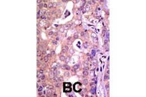 Formalin-fixed and paraffin-embedded human cancer tissue reacted with the primary antibody, which was peroxidase-conjugated to the secondary antibody, followed by AEC staining. (USP1 anticorps  (C-Term))