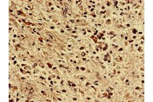 Immunohistochemistry analysis of human glioma using ABIN7176355 at dilution of 1:100 (ZNF529 anticorps  (AA 393-563))