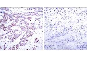 Immunohistochemistry analysis of paraffin-embedded human breast carcinoma, using STAT6 (Phospho-Thr645) Antibody. (STAT6 anticorps  (pThr645))