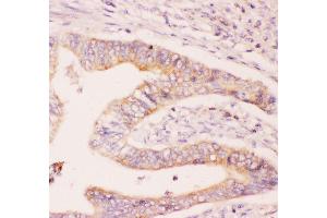 Anti-MCL1 Picoband antibody,  IHC(P): Human Intestinal Cancer Tissue (MCL-1 anticorps  (AA 1-350))