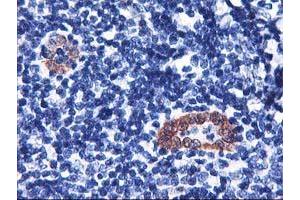 Immunohistochemical staining of paraffin-embedded Human lymphoma tissue using anti-LMCD1 mouse monoclonal antibody.
