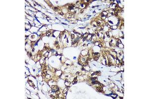 Immunohistochemistry of paraffin-embedded Human colon carcinoma using TSN Rabbit pAb  at dilution of 1:100 (40x lens). (Translin anticorps  (AA 50-150))