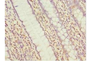 Immunohistochemistry of paraffin-embedded human colon cancer using ABIN7160535 at dilution of 1:100 (MYLK3 anticorps  (AA 1-240))