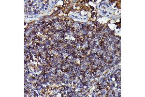 Immunohistochemistry of paraffin-embedded Human anaplastic large cell lymphoma using Human IgM Rabbit mAb (ABIN7267845) at dilution of 1:100 (40x lens). (IGHM anticorps)