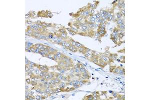 Immunohistochemistry of paraffin-embedded human liver cancer using COQ7 antibody. (Coq7 anticorps)