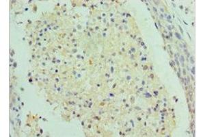 Immunohistochemistry of paraffin-embedded human cervical cancer using ABIN7155341 at dilution of 1:100 (SAP18 anticorps  (AA 2-153))