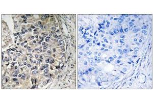 Immunohistochemistry analysis of paraffin-embedded human prostate carcinoma tissue using CMC1 antibody. (SLC25A12 anticorps  (Internal Region))