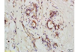 Formalin-fixed and paraffin embedded human breast carcinoma labeled with Anti-NLRX1 Polyclonal Antibody, Unconjugated (ABIN1385925) at 1:200 followed by conjugation to the secondary antibody and DAB staining (NLRX1 anticorps  (AA 111-210))