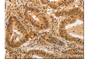 The image on the left is immunohistochemistry of paraffin-embedded Human colon cancer tissue using ABIN7189699(ADRA1B Antibody) at dilution 1/20, on the right is treated with synthetic peptide. (ADRA1B anticorps)