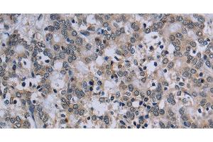 Immunohistochemistry of paraffin-embedded Human liver cancer tissue using TP53AIP1 Polyclonal Antibody at dilution 1:50 (TP53AIP1 anticorps)